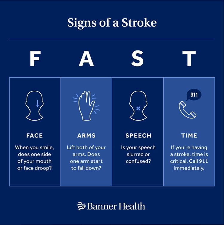 FAST Recognizing Stroke Signs