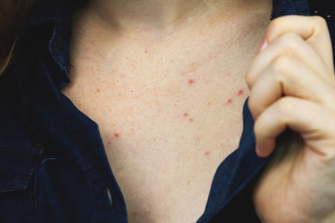 Tips for Preventing and Getting Rid of Shoulder Acne