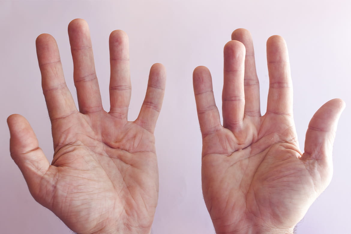 Hands Locking Up: Anxiety, Trigger Finger, Other Causes