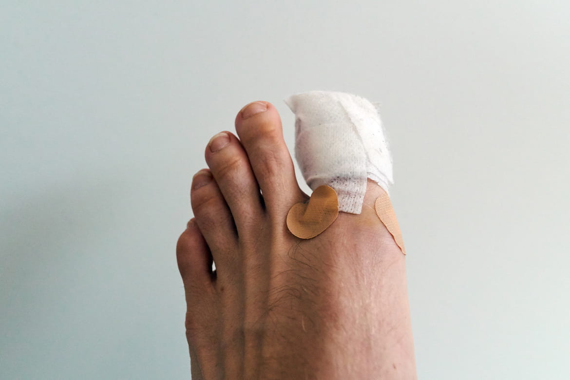 What to Do About Toenail Trauma and Injuries | Banner Health
