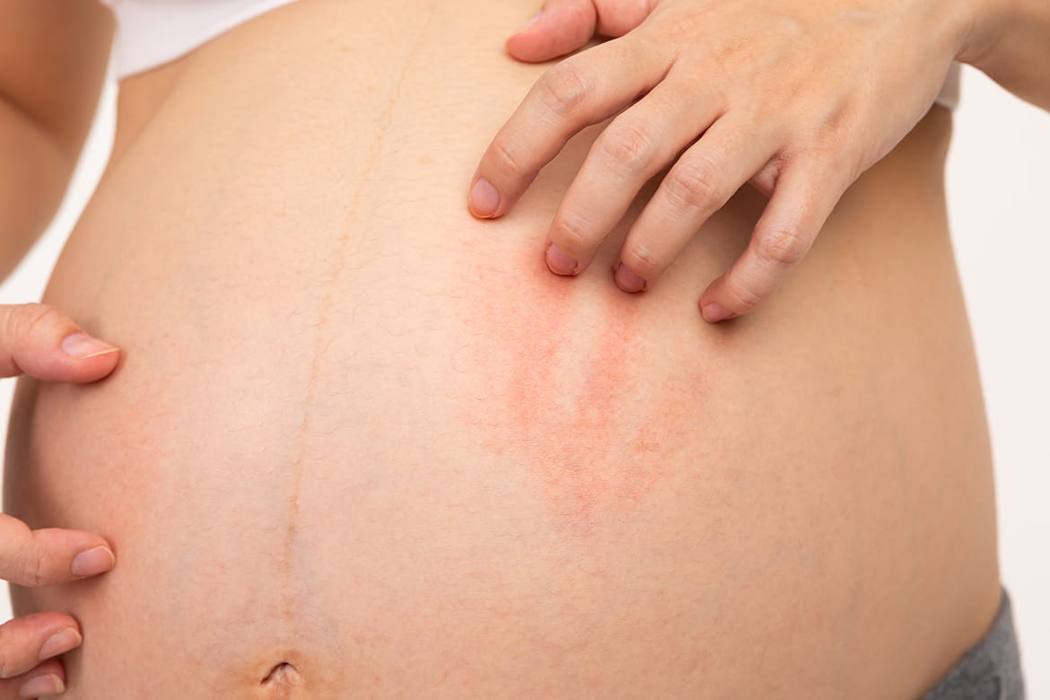 Pruritic Urticarial Papules and Plaques of Pregnancy