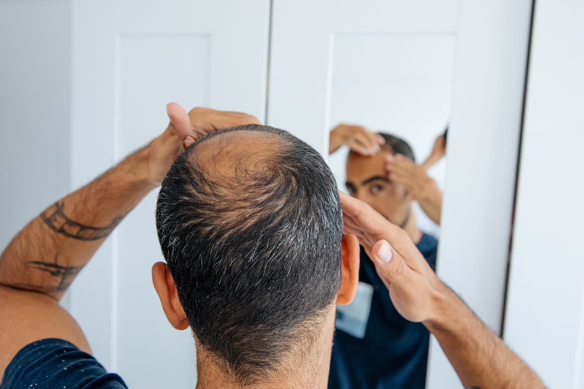 The Basics of Balding: Causes, Signs, and Treatments | Banner