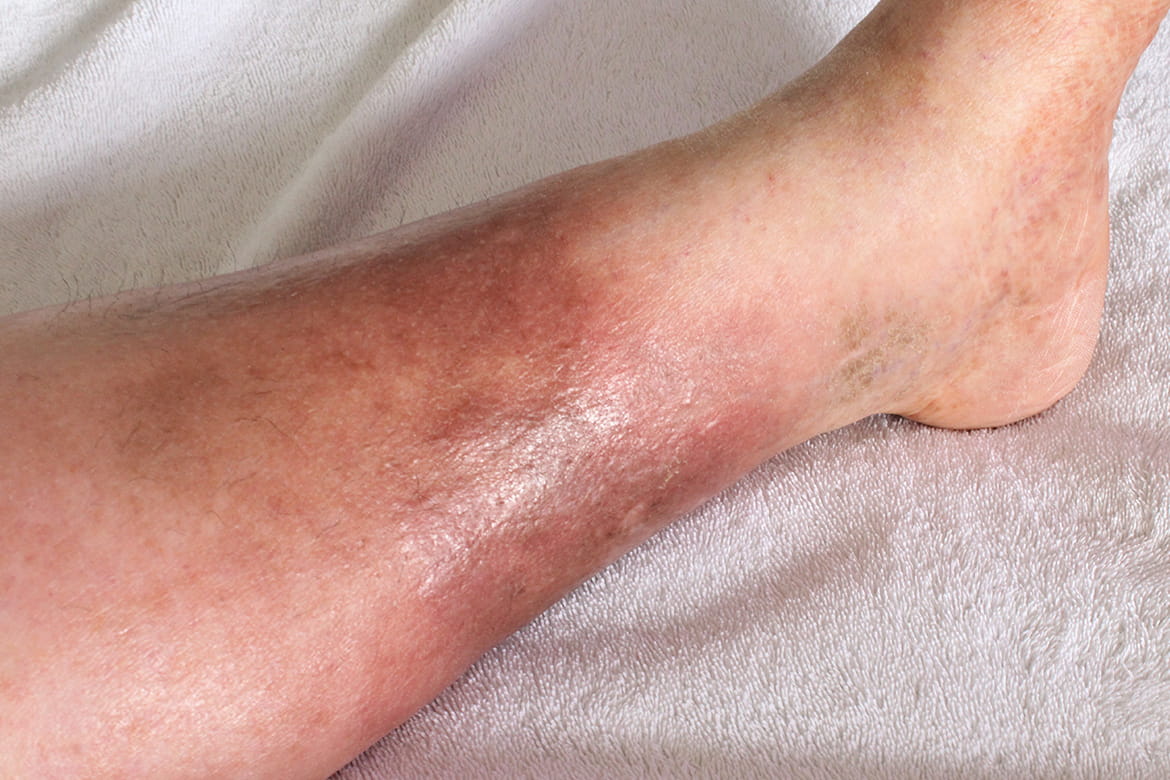 Heres What You Should Know About Cellulitis Banner Health